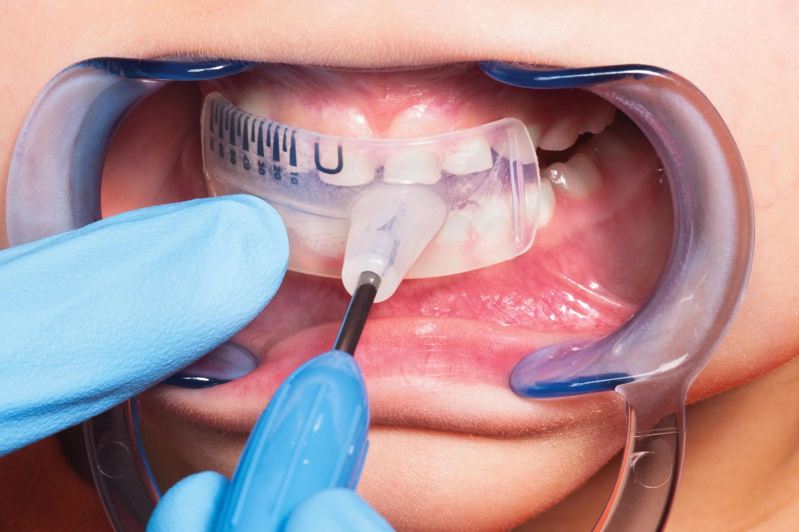 ЛІНІЙКА LM-ORTHOSIZER - 2277, Активатори, Ортодонтичні інструменти, Стоматологічні інструменти, фото, купити